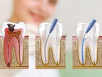 endodoncia