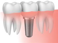 implantes